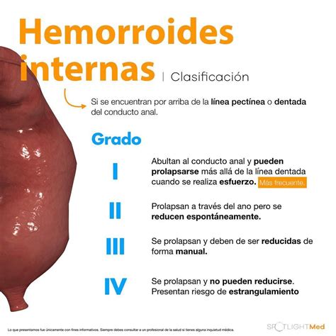 Tipos de hemorroides con fotos